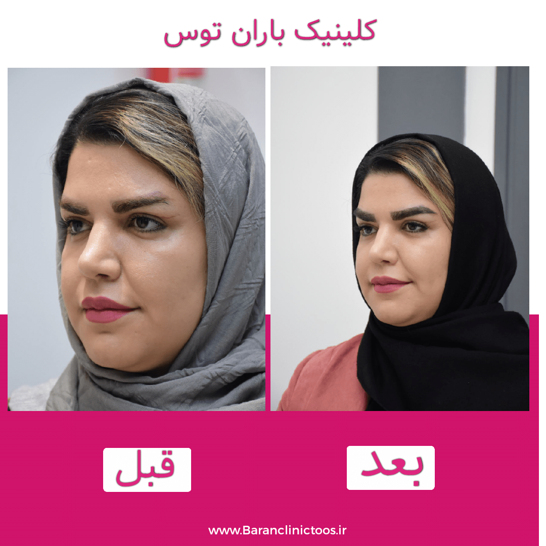 قبل و بعد کاشت ابرو